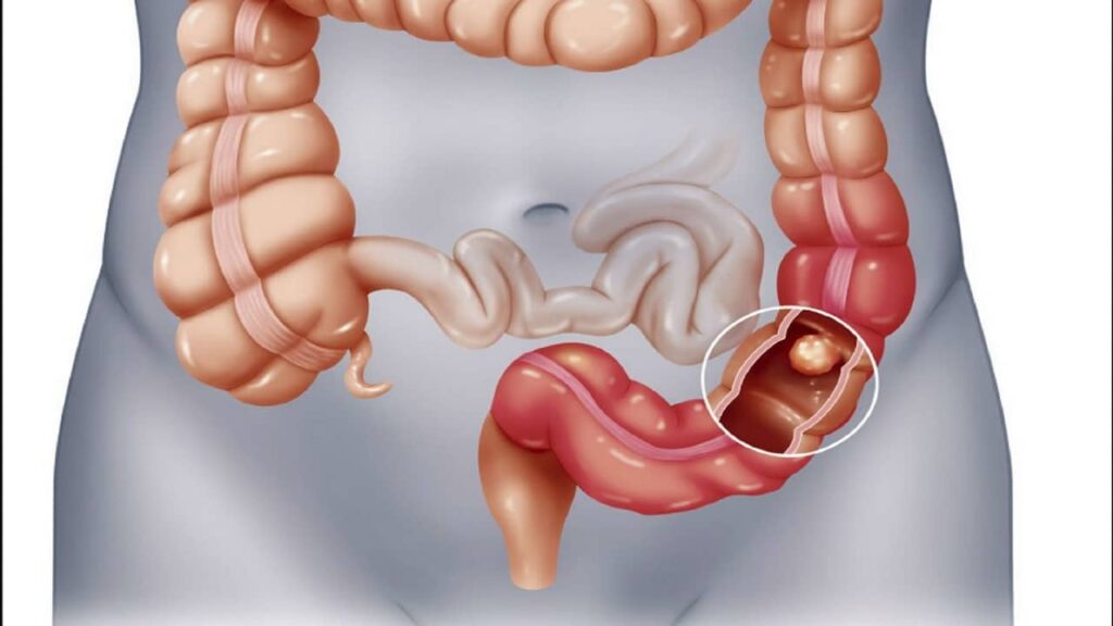 Παθήσεις γαστρεντερικής οδού: Σε τι διαφέρουν Σύνδρομο ευερέθιστου εντέρου - Νόσος του Crohn - Ελκώδης κολίτιδα