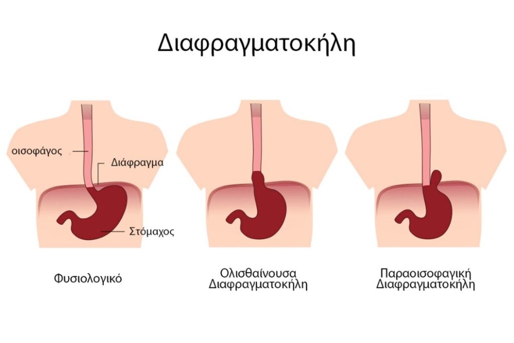 διαφραγματοκήλη