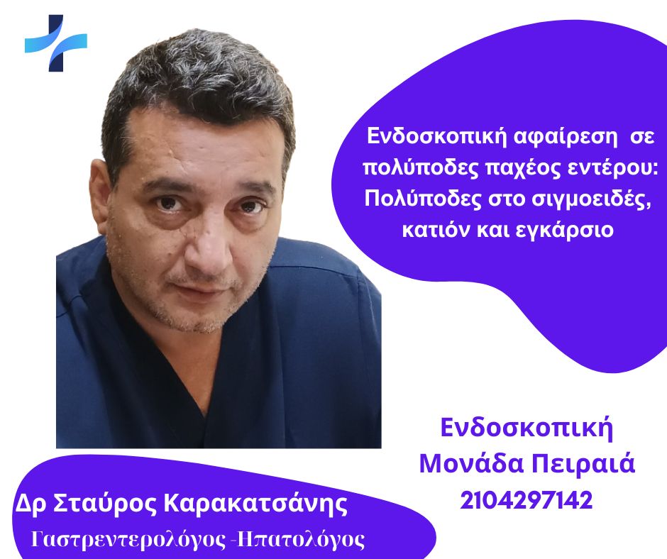 Ενδοσκοπική αφαίρεση (πολυπεκτομή) σε πολύποδες παχέος εντέρου: Πολύποδες στο σιγμοειδές, κατιόν και εγκάρσιο