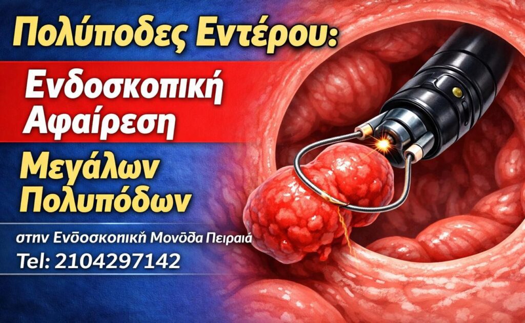 Πολύποδες Εντέρου: Ενδοσκοπική Πολυπεκτομή Μεγάλων Πολυπόδων | Γαστρεντερολόγος Πειραιάς
