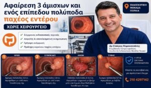 Αφαίρεση πολλαπλών πολυπόδων παχέος εντέρου στον Πειραιά από τον Δρ Σταύρο Καρακατσάνη