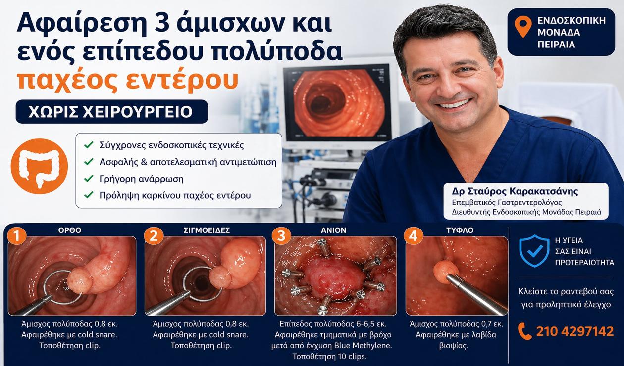 Αφαίρεση πολλαπλών πολυπόδων παχέος εντέρου στον Πειραιά από τον Δρ Σταύρο Καρακατσάνη