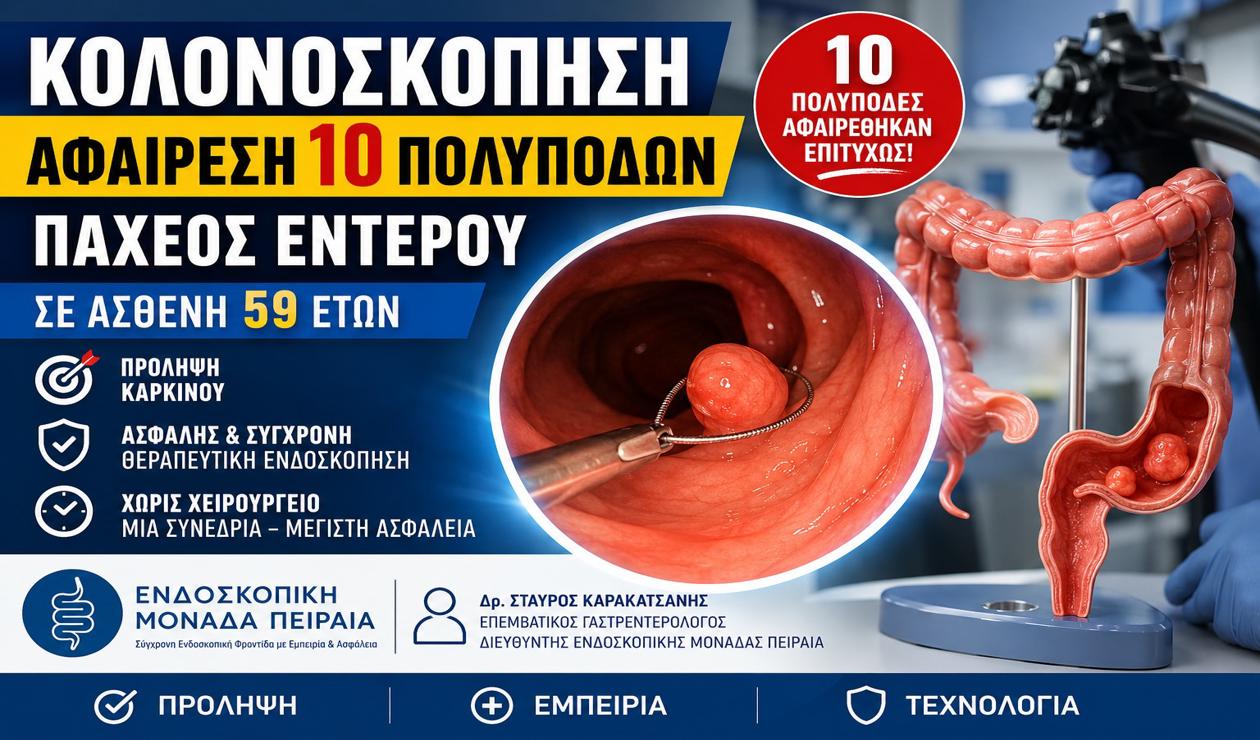 Κολονοσκόπηση στον Πειραιά: Επιτυχής αφαίρεση 10 πολυπόδων παχέος εντέρου χωρίς χειρουργείο
