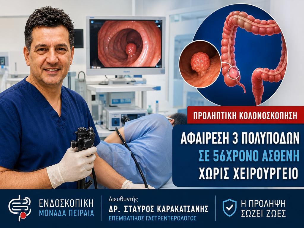 Προληπτική Κολονοσκόπηση: Αφαίρεση 3 Μεγάλων Πολυπόδων σε 56χρονο χωρίς Χειρουργείο | Ενδοσκοπική Μονάδα Πειραιά