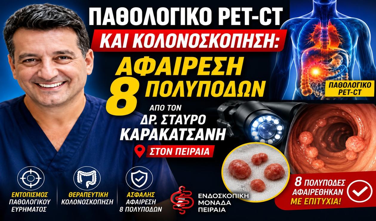 Παθολογικό PET-CT και Κολονοσκόπηση: Αφαίρεση 8 Πολυπόδων από τον Δρ. Σταύρο Καρακατσάνη στον Πειραιά