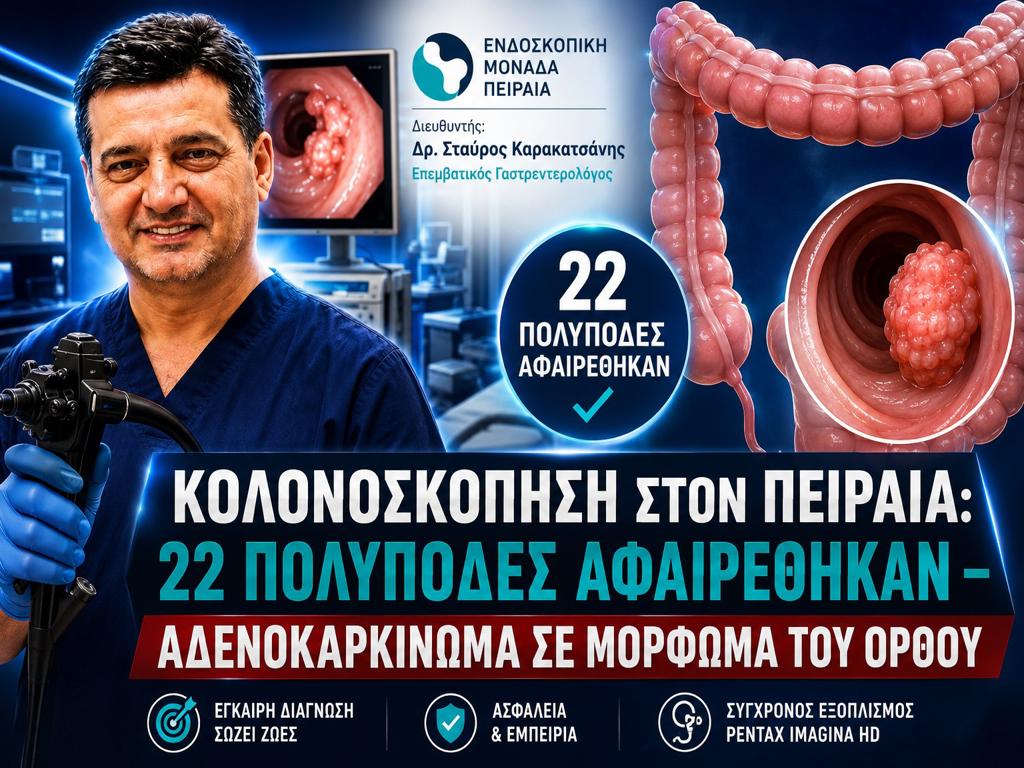 Κολονοσκόπηση στον Πειραιά: 22 Πολύποδες Αφαιρέθηκαν – Αδενοκαρκίνωμα σε Μόρφωμα του Ορθού