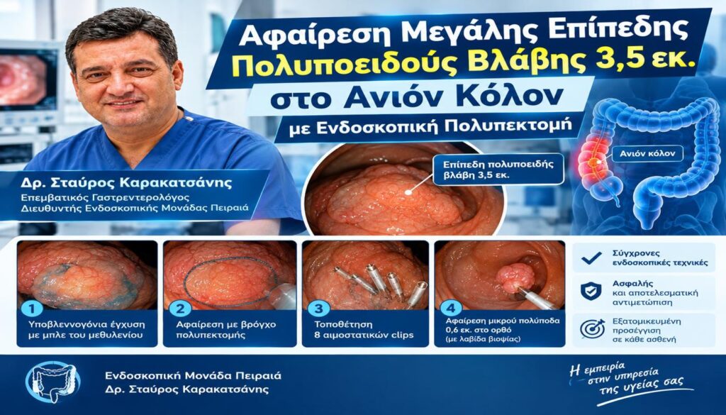 Αφαίρεση Μεγάλης Επίπεδης Πολυποειδούς Βλάβης 3,5 εκ. στο Ανιόν Κόλον με Ενδοσκοπική Πολυπεκτομή