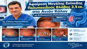 Αφαίρεση Μεγάλης Επίπεδης Πολυποειδούς Βλάβης 3,5 εκ. στο Ανιόν Κόλον με Ενδοσκοπική Πολυπεκτομή