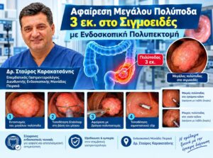 Αφαίρεση Μεγάλου Πολύποδα 3 εκ. στο Σιγμοειδές με Ενδοσκοπική Πολυπεκτομή